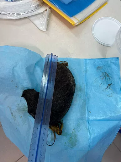 Врачи Ваныкинской больницы удалили из желудка ребенка огромный ком волос весом 750 граммов